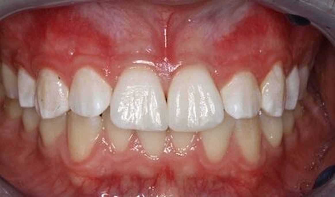 Estetica dentale: dopo il trattamento