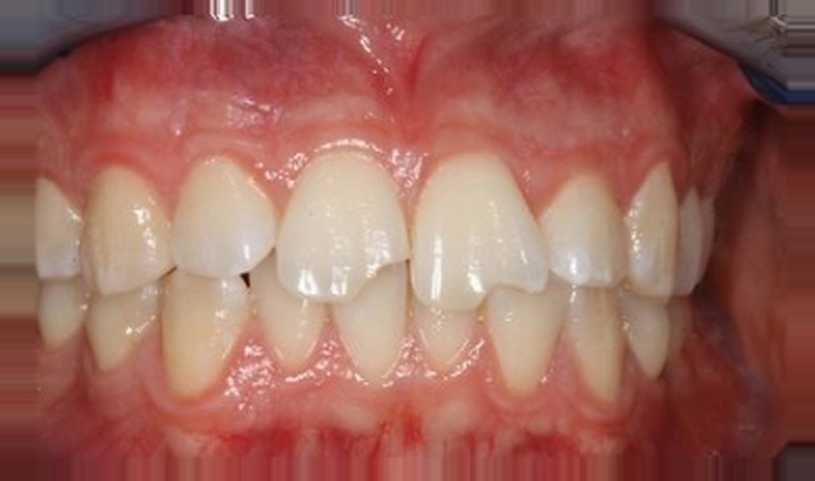 Estetica dentale: prima del trattamento