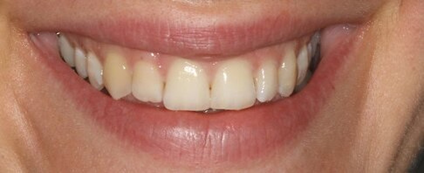 Estetica del sorriso: dopo il trattamento