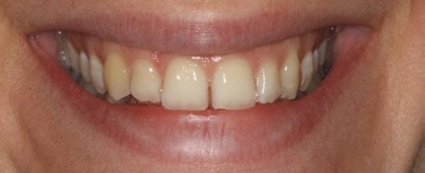 Estetica del sorriso: prima del trattamento